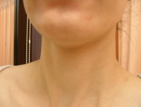 正面・お手入れ2ヵ月後